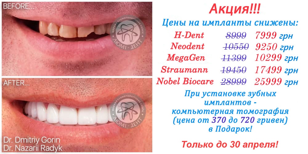 Имплантация Зубов- Киев Цена На Импланты- ЛюмиДент