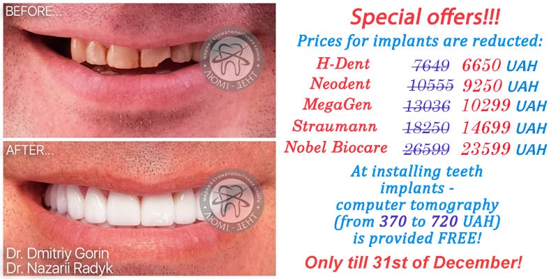 teeth implantation