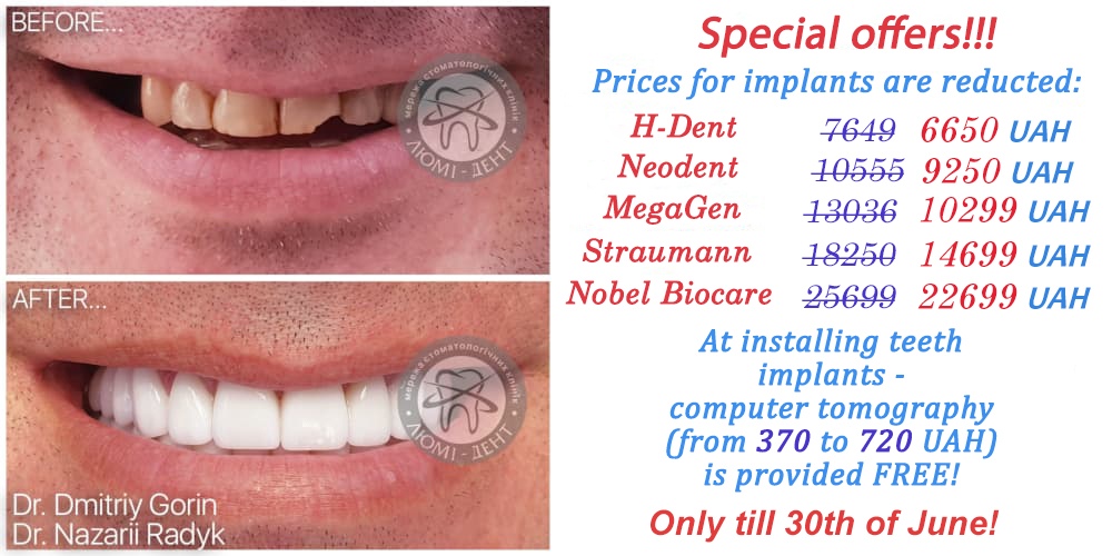 teeth implantation