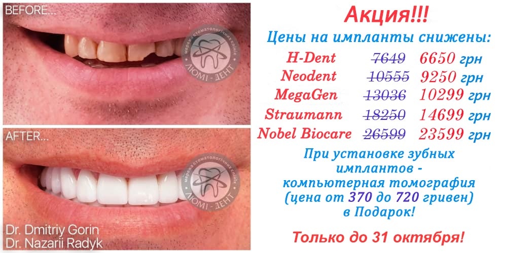 Зубные импланты фото Люми-Дент 