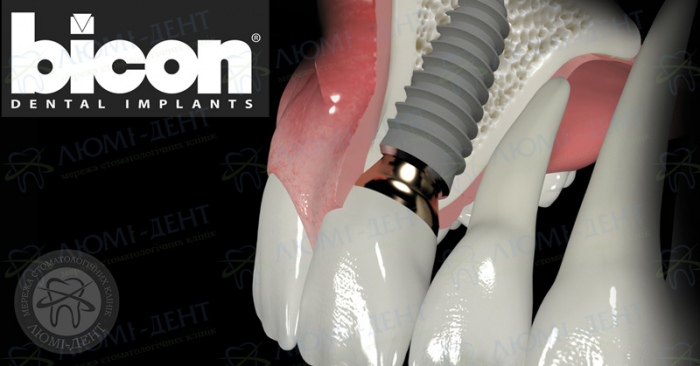 Bicon implant фото ЛюміДент