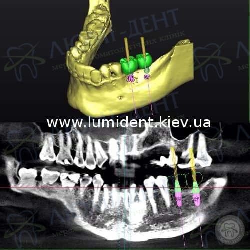 корейські імпланти ціна фото Люмі-Дент