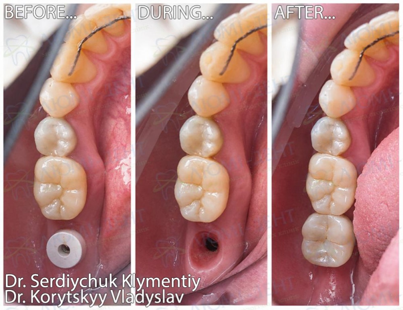 Имплантация зубными имплантами MIS
