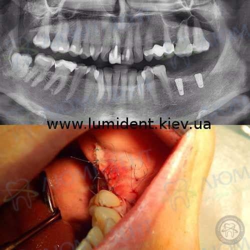 імпланти mis відгуки фото Люмі-Дент