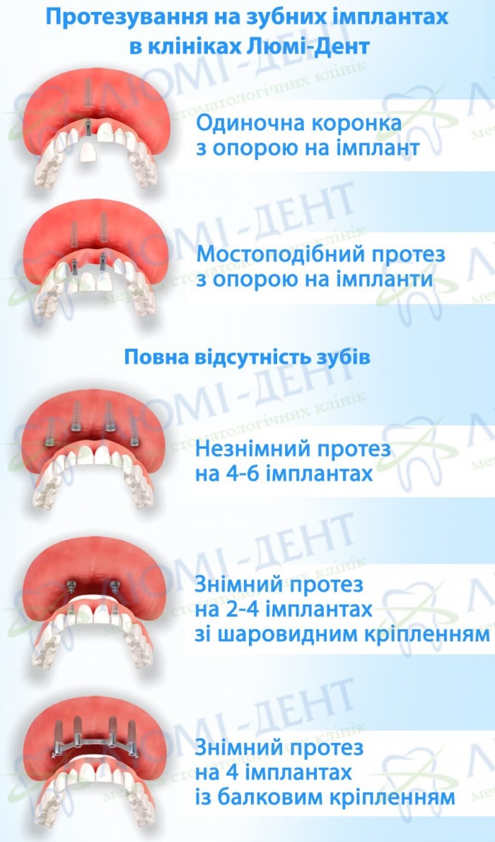 Види протезів зубів на імплантах