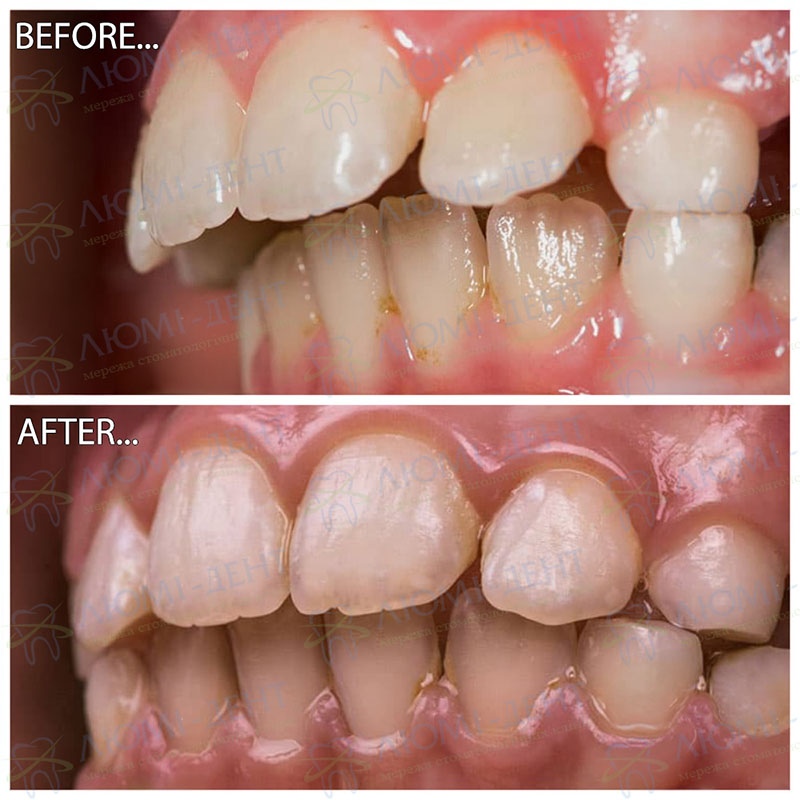 Пример использования капп в Люми-Дент Каппы Invisalign Инвизилайн Киев фото Люмидент