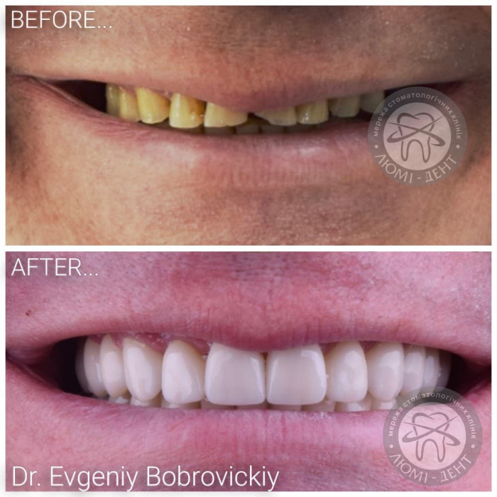 Crowns on teeth photo before after Lumi-Dent