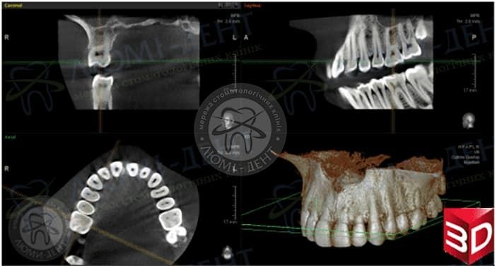 КТ челюсти фото Люми-Дент