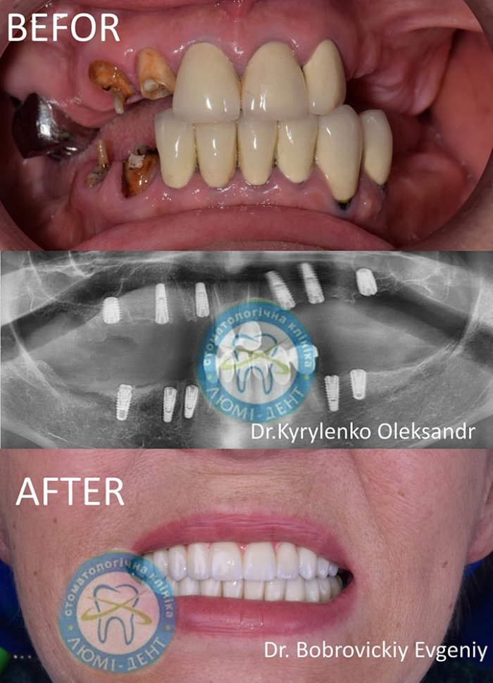 Імплант як ставлять на зуби фото Люмі-Дент