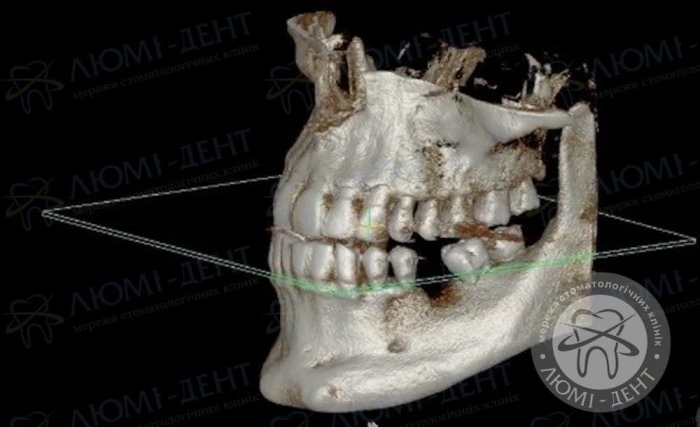 Встановлення імплантів зубів фото Люмі-дент
