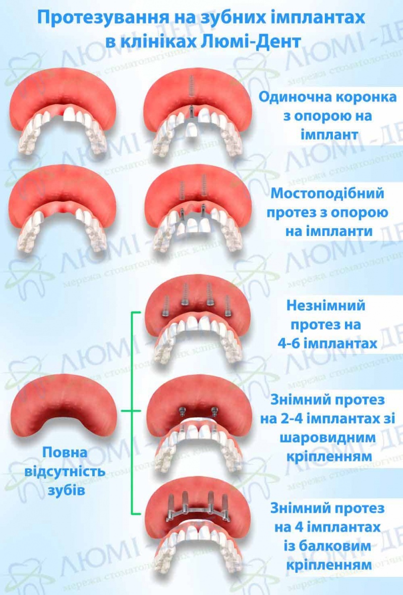 Як ставлять імпланти зубів фото Люмі-Дент