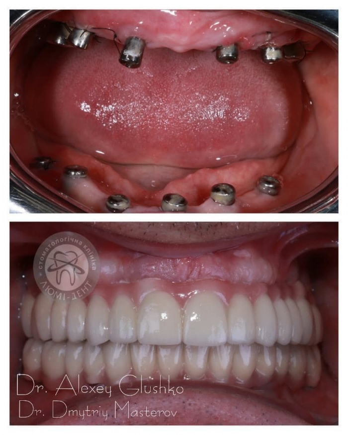Як встановлюють імплант зуба фото Люмі-Дент
