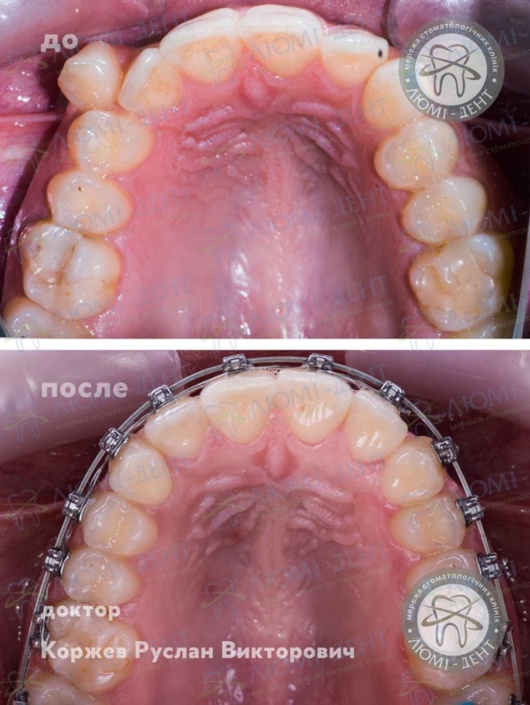 Як ставлять брекети на зуби фото Люмі-Дент