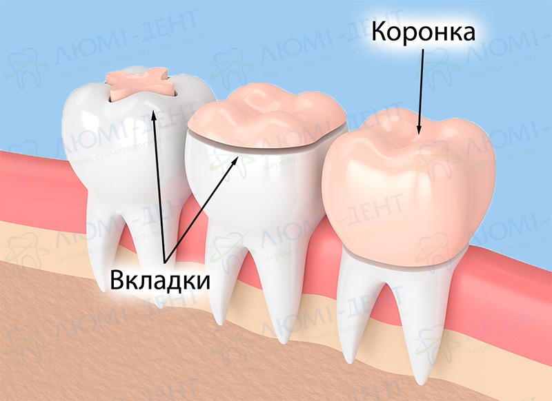 Керамические коронки Люми-Дент