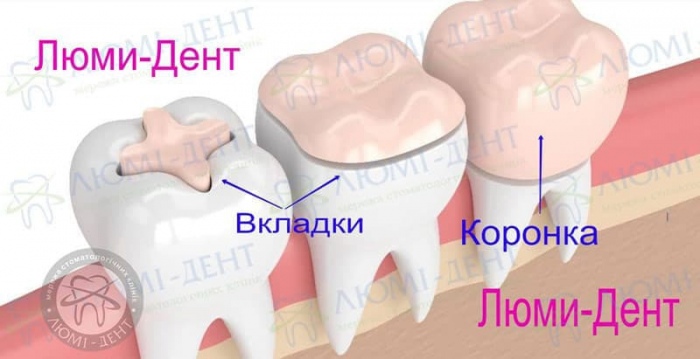 Керамическая вкладка на зуб фото Люми-Дент