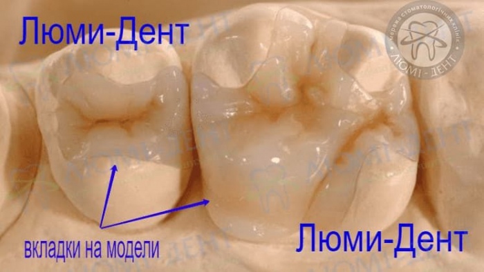 Керамические вкладки на зубы Киев фото Люми-Дент