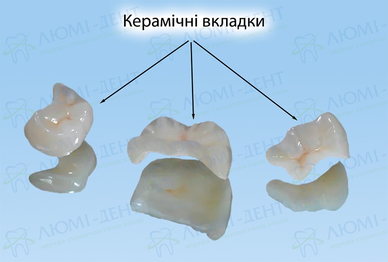 Керамічні вкладки на зуби фото Люмі-Дент