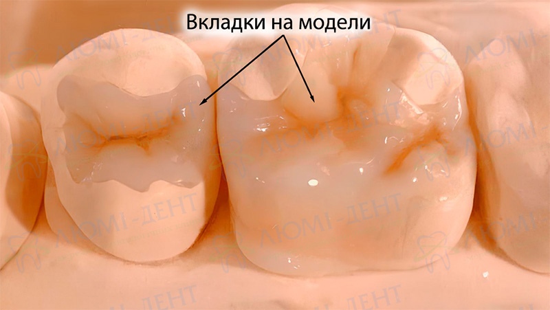 Керамическая вкладка на гипсовой модели Керамические вкладки в зубы Киев фото Люми-Дент