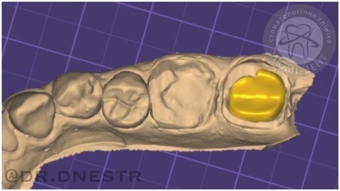 керамічна накладка на зуб фото Люмі-Дент