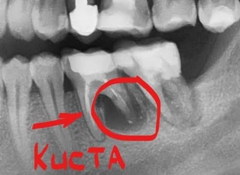 Зубная киста на рентгене фото Люми-Дент