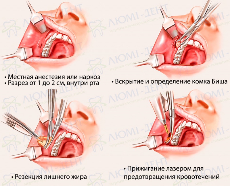 Удаление жировых комочков Биша со щек Комки биша стоимость удаления фото Люми-Дент