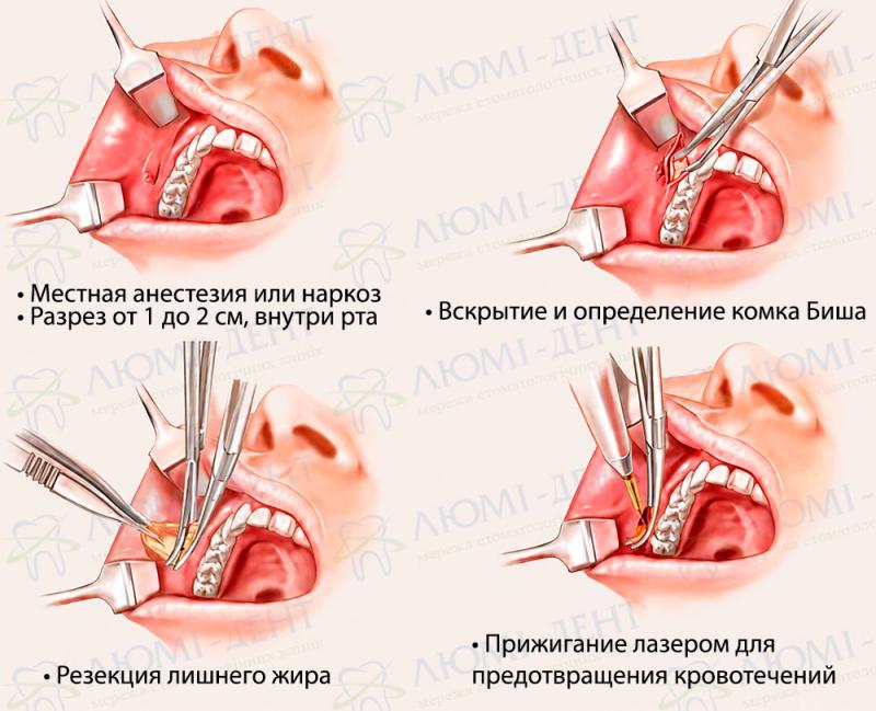 Удаление жировых комочков Биша со щек Комки биша стоимость удаления фото Люми-Дент