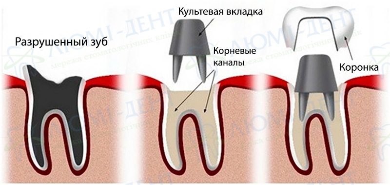 Схема изготовления коронки на штифте Как ставят коронки на зубы Люми-Дент
