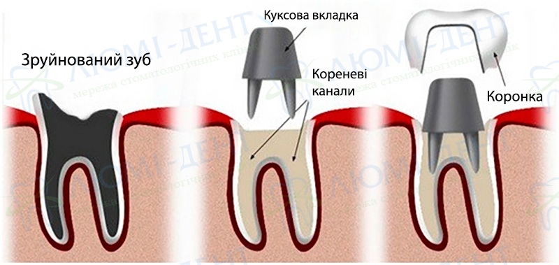 Схема виготовлення коронки на штифті Як ставлять коронки на зуби Люмі-Дент