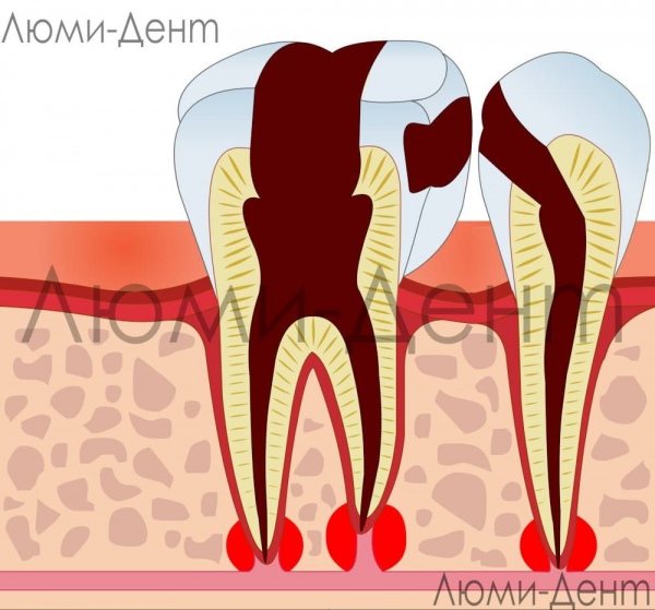 Лечение нерва зуба фото Люми-Дент