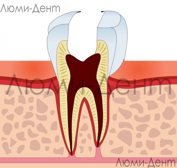Лечение зубных нервов фото Люми-Дент