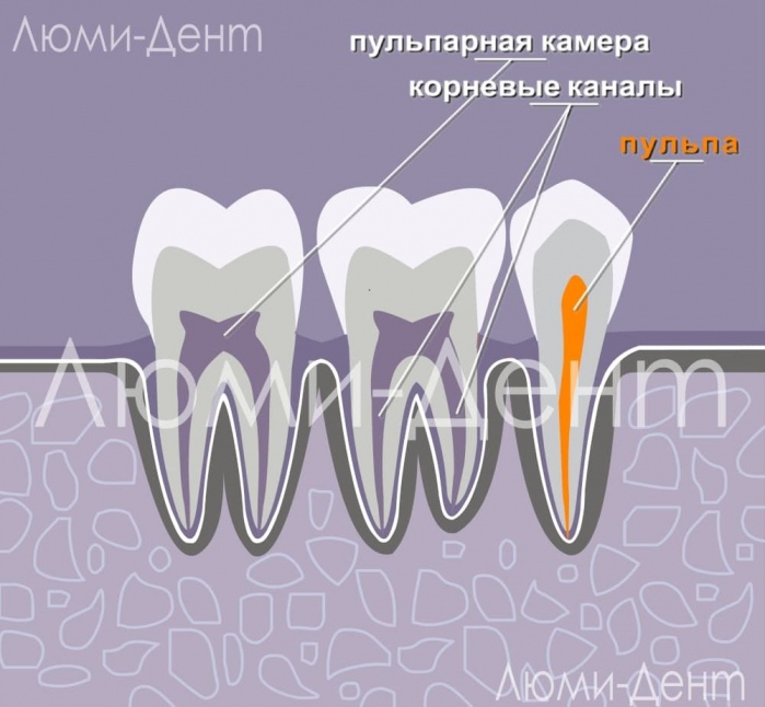 Удаление нерва зуба лечение каналов фото Люми-Дент