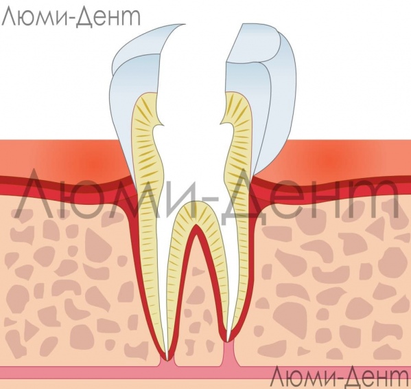 Удаление нерва зуба фото Люми-Дент