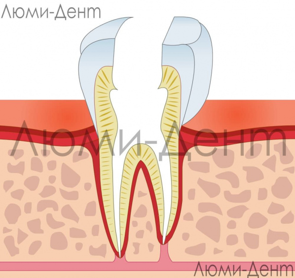 Удаление нерва из зуба фото Люмидент