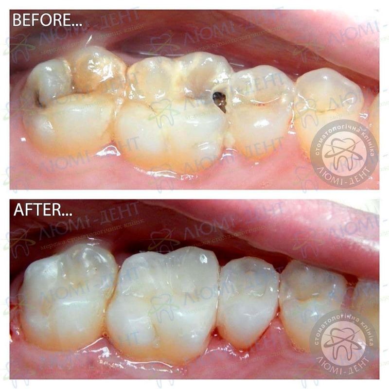 Tooth treatment photo LumiDent