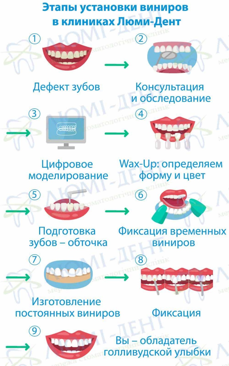 виниры на зубы фото Люми-Дент