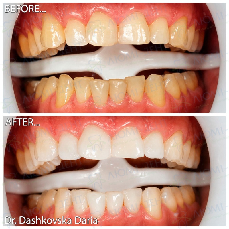 Результат відбілювання в Люмі-Дент Magic Smile фото Київ Люмі-Дент