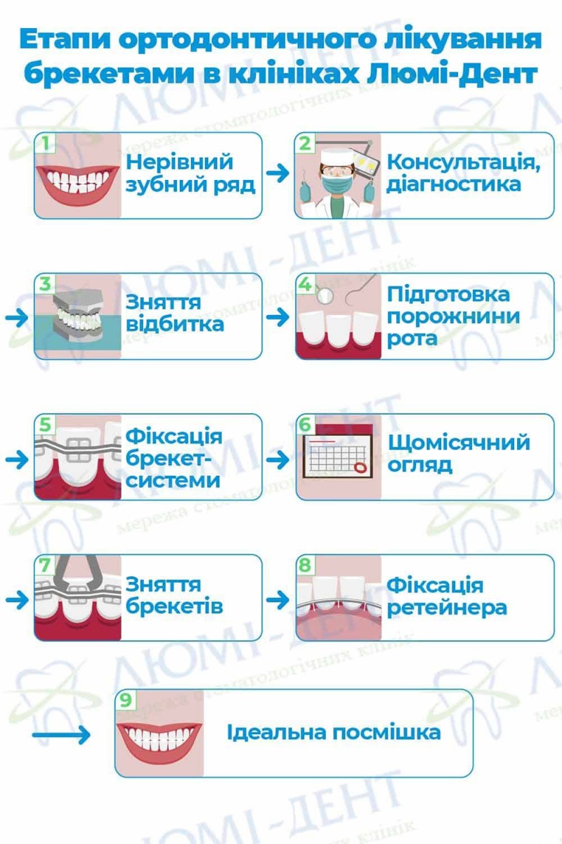 Етапи встановлення брекет систем Металеві брекети Люмі-Дент