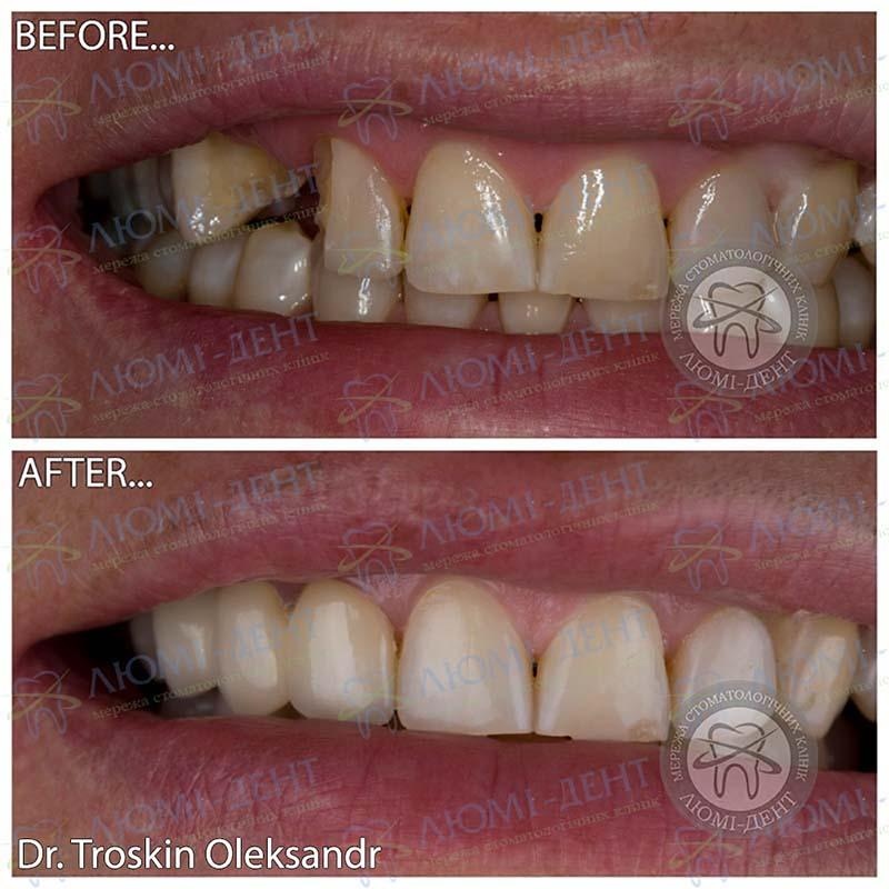 Зубы из металлокерамики Люми-Дент