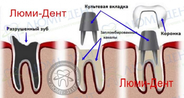 металлокерамика зубов коронки фото Люми-Дент