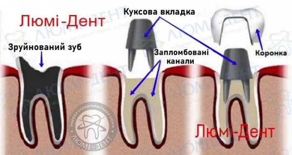 металокераміка зубів коронки фото Люмі-Дент