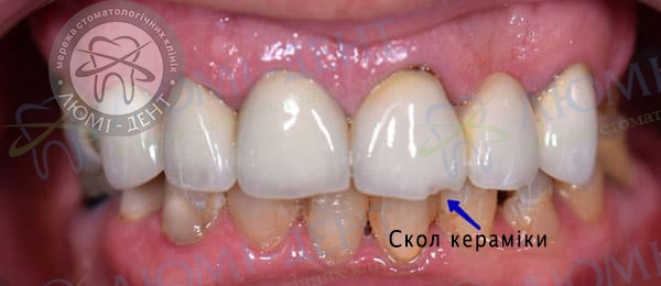 Металокераміка зубів Київ фото