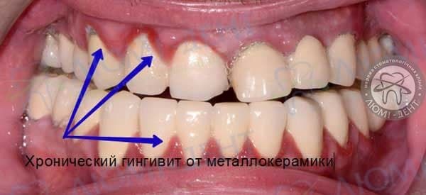 Металлокерамика зубов Киев фото
