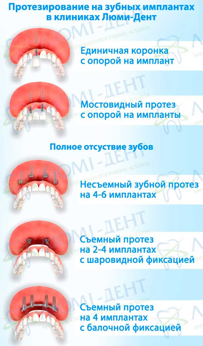 Имплантация зубов виды методы фото Люми-Дент