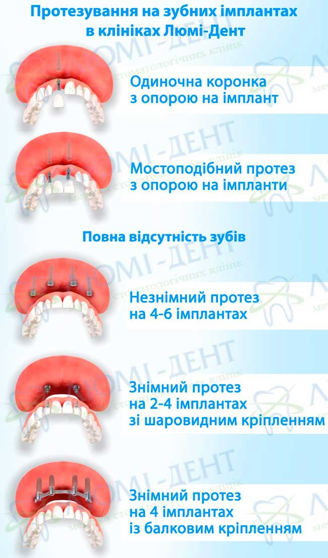 Імплантація зубів види методи фото Люми-Дент