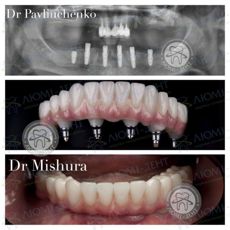 Відторгнення імпланту зуба фото Люмі-Дент