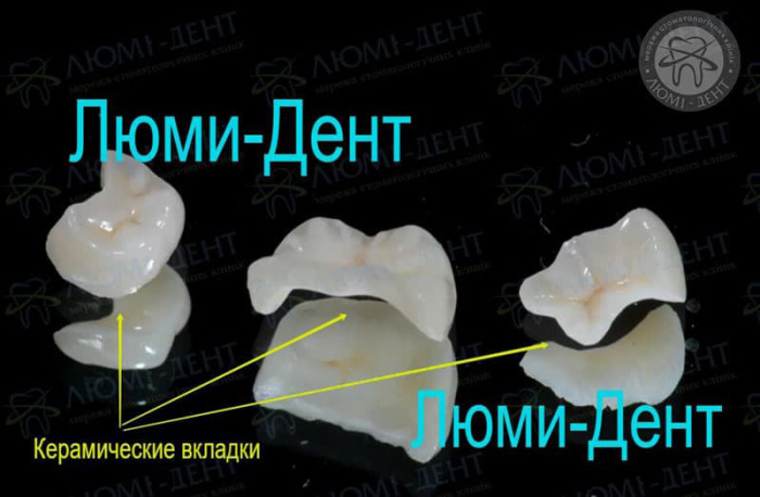 Керамические вкладки на зубы Киев фото Люми-Дент