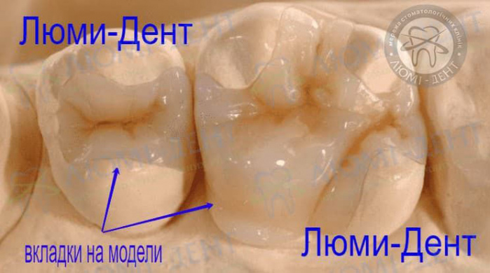 Керамические вкладки на зубы Киев картинки Люми-Дент 