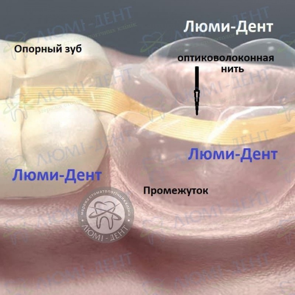 Адгезивный мост Киев фото Люми-Дент