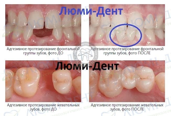 Адгезивный мост на зубы фото Люми-Дент