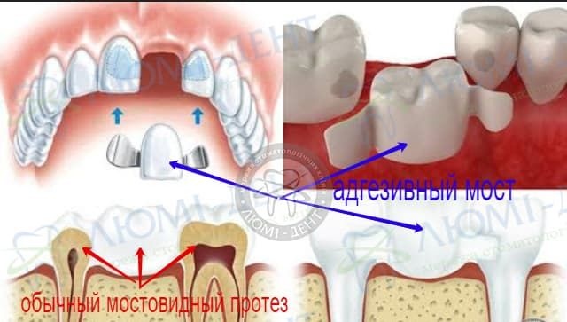 Адгезивный мост на зубы фото Люми-Дент